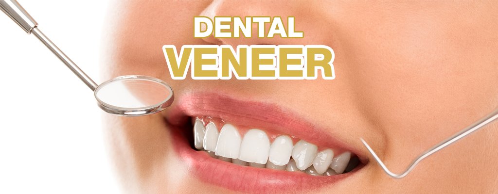 Dental veneer